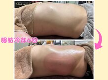 サロンドモモ(SALON de MOMO)/脂肪冷却★お腹ビフォーアフター