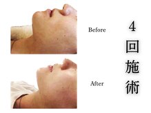 アロエベル(aloe Belle)/Before After（4回施術）