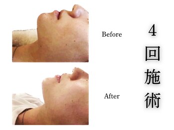 アロエベル(aloe Belle)/Before After（4回施術）