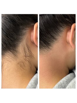 エピリア(Epilear)/小学生うなじWax