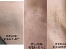 エイプリルプラス(April plus)/脇脱毛