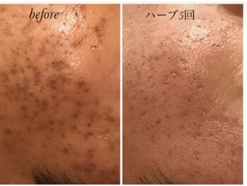 ドリームローズ(Dream Rose)/ニキビケア