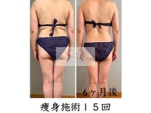 アイ エステサロン(Ai)/【40代】背中のお肉もスッキリ♪