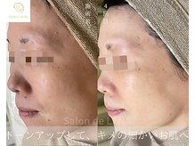 サロンドレナ 名駅店/ハーブピーリング サロンドレナ