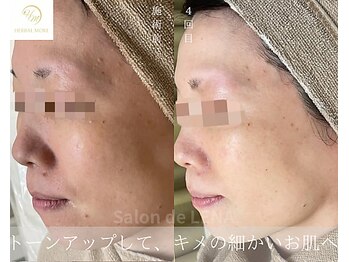 サロンドレナ 名駅店/ハーブピーリング サロンドレナ