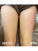 サロン ド ノーブル/【太もも】ビフォーアフター
