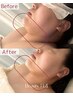 【35歳以降の方限定】たるみ・二重顎・口横ポニョ撃退フェイス60分13,200円