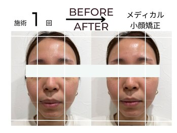 ベガ(Vega)/小顔矯正