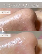 ココロ(COCORO)/ハイドラネオ　ビフォーアフター