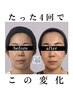 【小顔矯正＋美肌美顔器４回モニターコース】通常39,600円→モニター22,000円