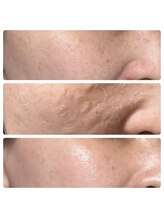 シャナ(Shana)/ゾンビマスク