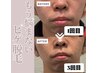 【メンズヒゲ脱毛回数券10回】全顔ヒゲ脱毛 ※期間限定※