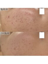 ヴェルシック(Belchic)/月1のハーブで美肌をキープ