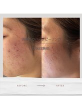 べっぷ餅ヶ浜鍼灸院/ハーブピーリングBefore/ After