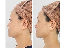 リンド(Lindo)の雰囲気（NEW★3D筋膜ストレッチ小顔術　1回の施術結果/小顔・持続性◎）