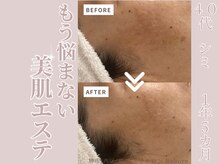 リボーン(Reborn)/４０代　シミケア(１年5ヶ月)