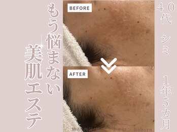リボーン(Reborn)/４０代　シミケア(１年5ヶ月)