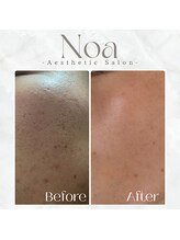 ノア 新宿(Noa)/ピーリング＋ポレーション　10回