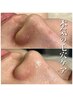 大人気★徹底毛穴集中ケア【全顔】¥13000→¥9800
