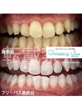 ホワイトニングサロン 福岡天神店/ホワイトニング