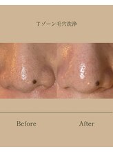 パンセリーノ(Panselinos)/Tゾーン毛穴洗浄