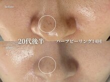 コウル 川西能勢口店(geoul)/毛穴レス美肌コース＋毛穴洗浄