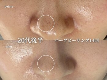 コウル 川西能勢口店(geoul)/毛穴レス美肌コース＋毛穴洗浄