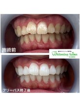 ホワイトニングサロン 名古屋駅店/【ホワイトニング施術例】