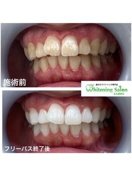 ホワイトニングサロン 名古屋駅店/【ホワイトニング施術例】