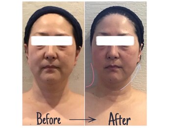 小顔フェイスラボ 大津京駅前店(小顔 Face Labo.)/小顔&整体コルギの変化