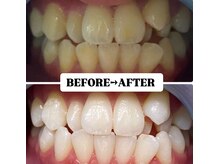 ホワイトニングサロン 豊中/Before&After美白ホワイトニング