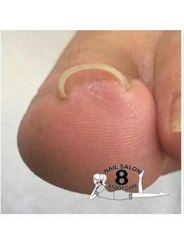 ネイルエイト 新百合ヶ丘(nail8)/2-1 巻き爪補正 片側のみ