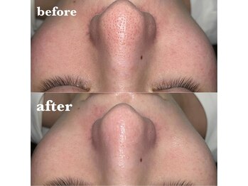 リファラ 光の森店(REFALA)/毛穴・ニキビケア専門REFALA