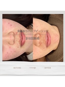 べっぷ餅ヶ浜鍼灸院/ハーブピーリングBefore/ After