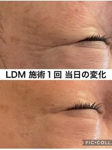 リラ(Lilas) LDM 