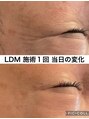 リラ(Lilas) LDM