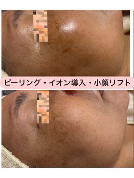 トータルビューティー ココ(Total Beauty CoCo)/60代・ピーリング×イオン導入