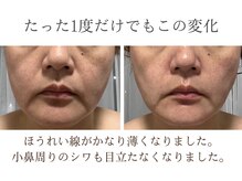 ココカラ(COCOKARA)/神経系幹細胞導入で劇的変化！