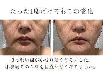 ココカラ(COCOKARA)/神経系幹細胞導入で劇的変化!