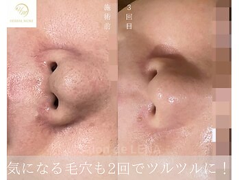 サロンドレナ 名駅店/ハーブピーリング サロンドレナ