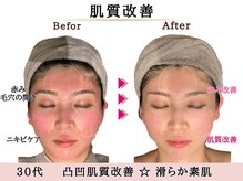 グレースエール トータルビューティーサロン(Grace Aile)/肌質改善