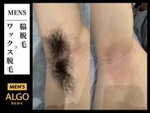 アルゴ 小倉守恒店(ALGO)/脇ワックス脱毛