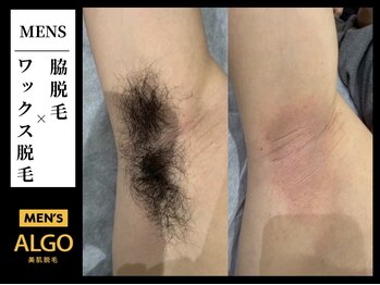 アルゴ 小倉守恒店(ALGO)/脇ワックス脱毛