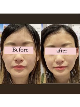 アリウム(Allium)/痩身機械で小顔へ