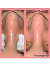 ビユ 大泉店(BIYU)/毛穴洗浄