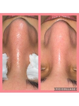 ビユ 大泉店(BIYU)/毛穴洗浄