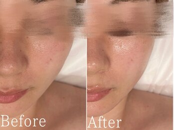 サージュクロレ 松戸店(sage colorer)/ハイパーナイフフェイシャル