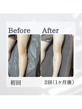 ティグレ 岡山店(TIGRE)/メンズ全身脱毛(顔VIO込)