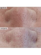 ヴェルシック(Belchic)/日焼け止めが埋まらない毛穴へ