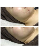 リラーナ(Re rana)/大きめニキビにも◎